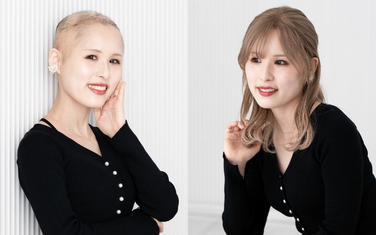 「寝ているときもウィッグをつけていた」結婚後も“夫に頭を隠し続ける”生活…“生まれつき髪が少ない病気”の女性が明かす、ありのまま姿を見た夫の予想外の反応 | 文春オンライン