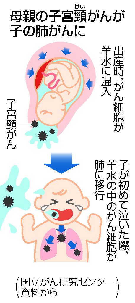 母親の 子宮頸がん が羊水から赤ちゃんに移行 肺がん を発症したケースが2例 極めて稀だが 文春オンライン