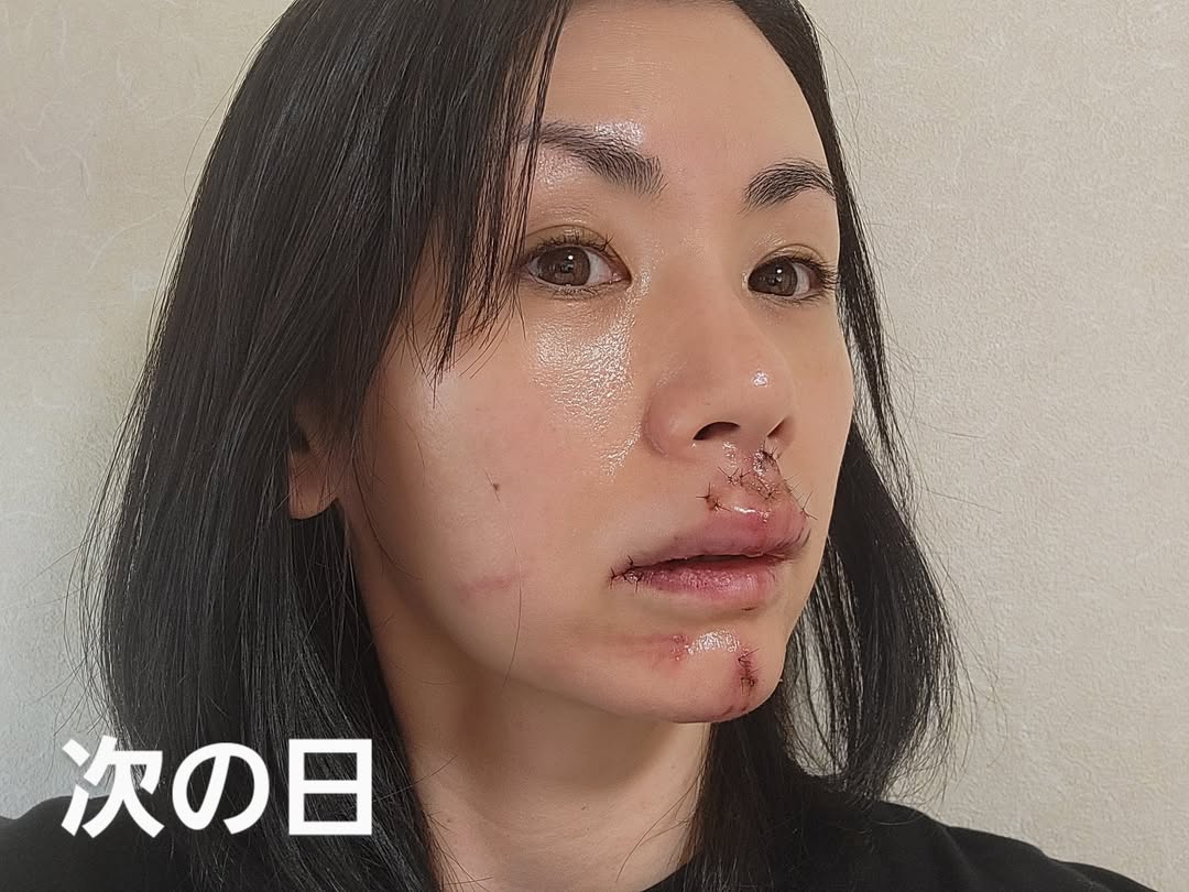 [写真](56ページ目)ピューッと顔から出血、「くちびるが3倍 …