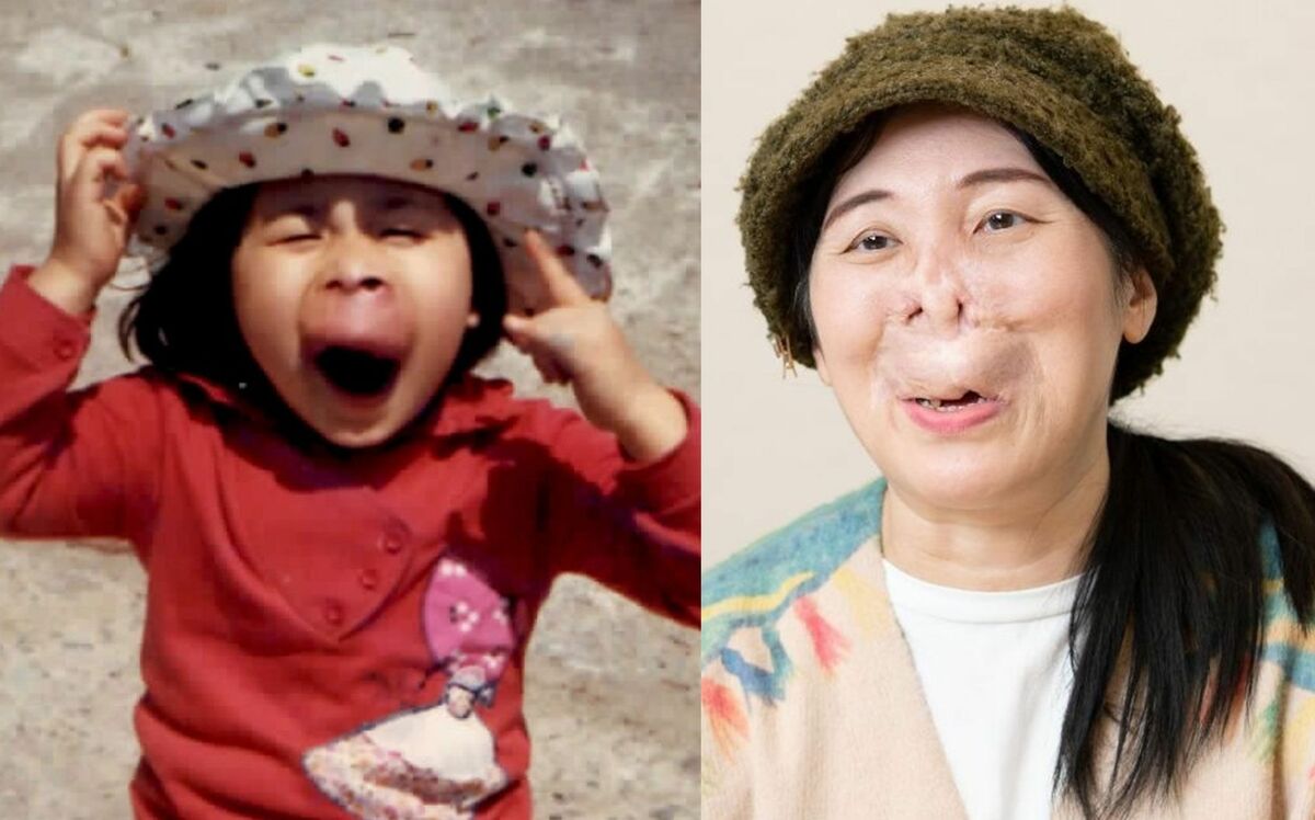 母は隠さず「奇形児やから」と…“アヒルのガーコ”と呼ばれた難病の女性(51)が明かす、40回以上の手術と“鼻を作る”決断をした理由 | 文春オンライン