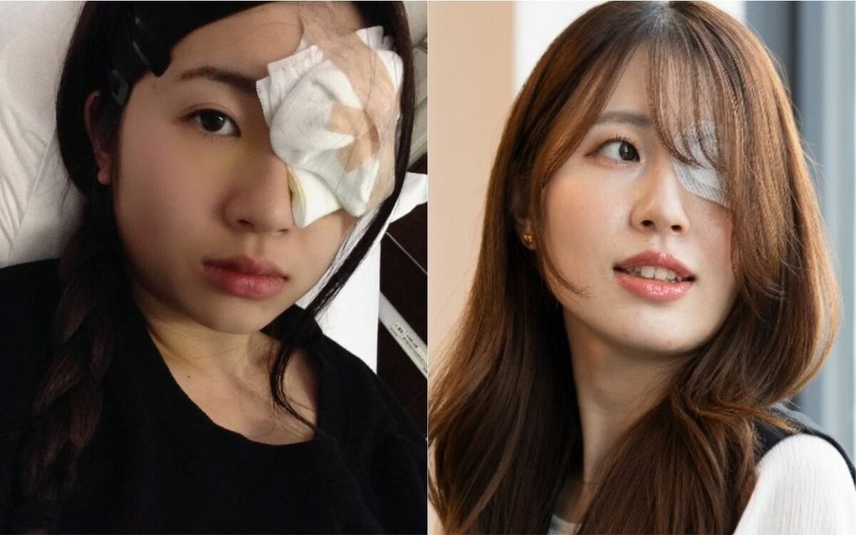 「バイト中、割れたグラスが左目に刺さった」「眼球が破裂し、グロテスクな見た目に」19歳で片目を“ほぼ失明”した女性の壮絶な体験 | 文春オンライン