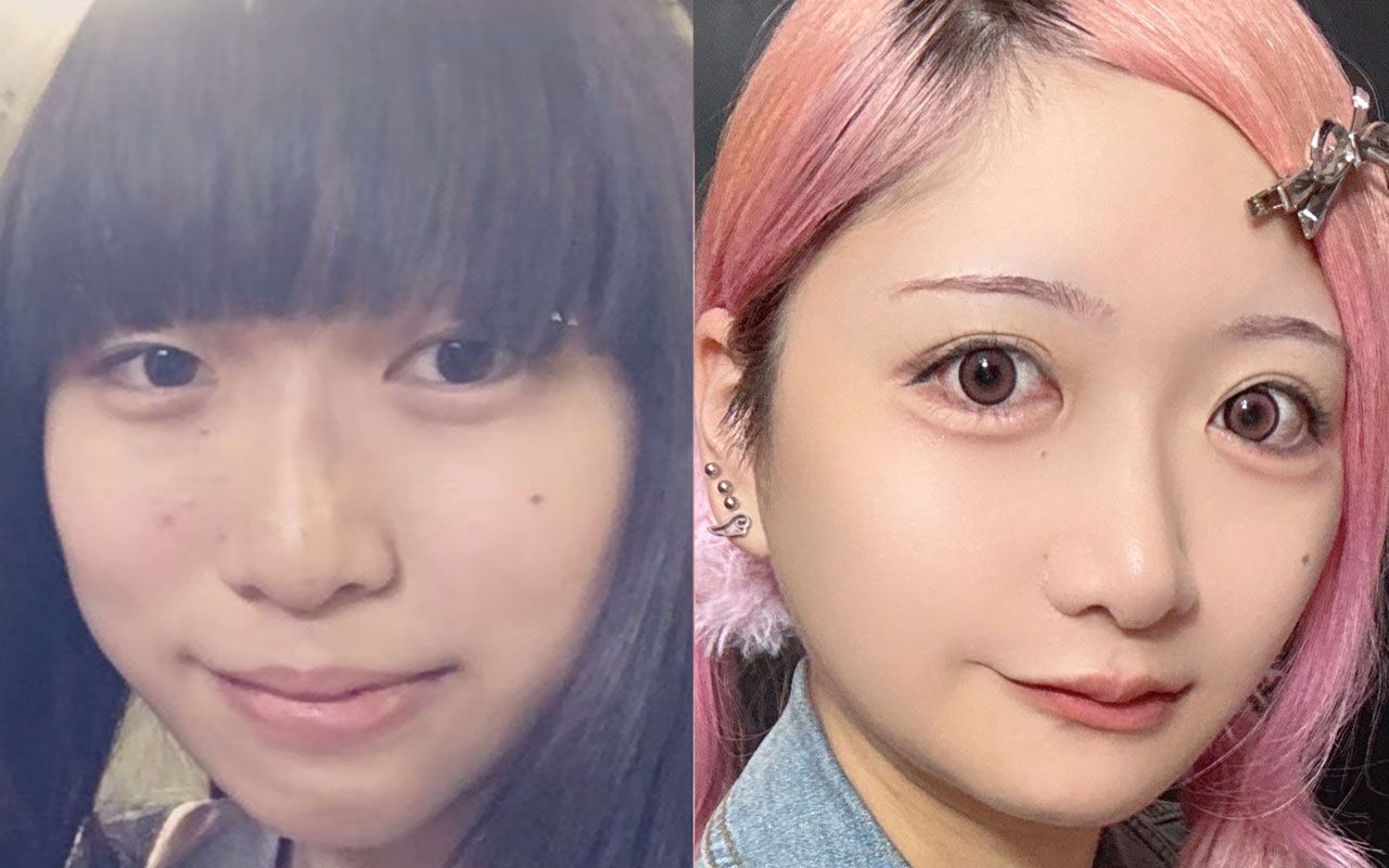 小6でコンプレックスを抱き、高2で手術を決断…総額1000万円以上を美容